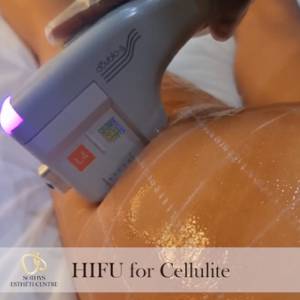 HIFU for Cellulite