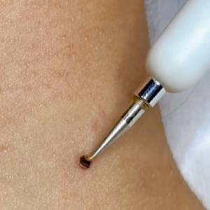 Skin Tag Removal